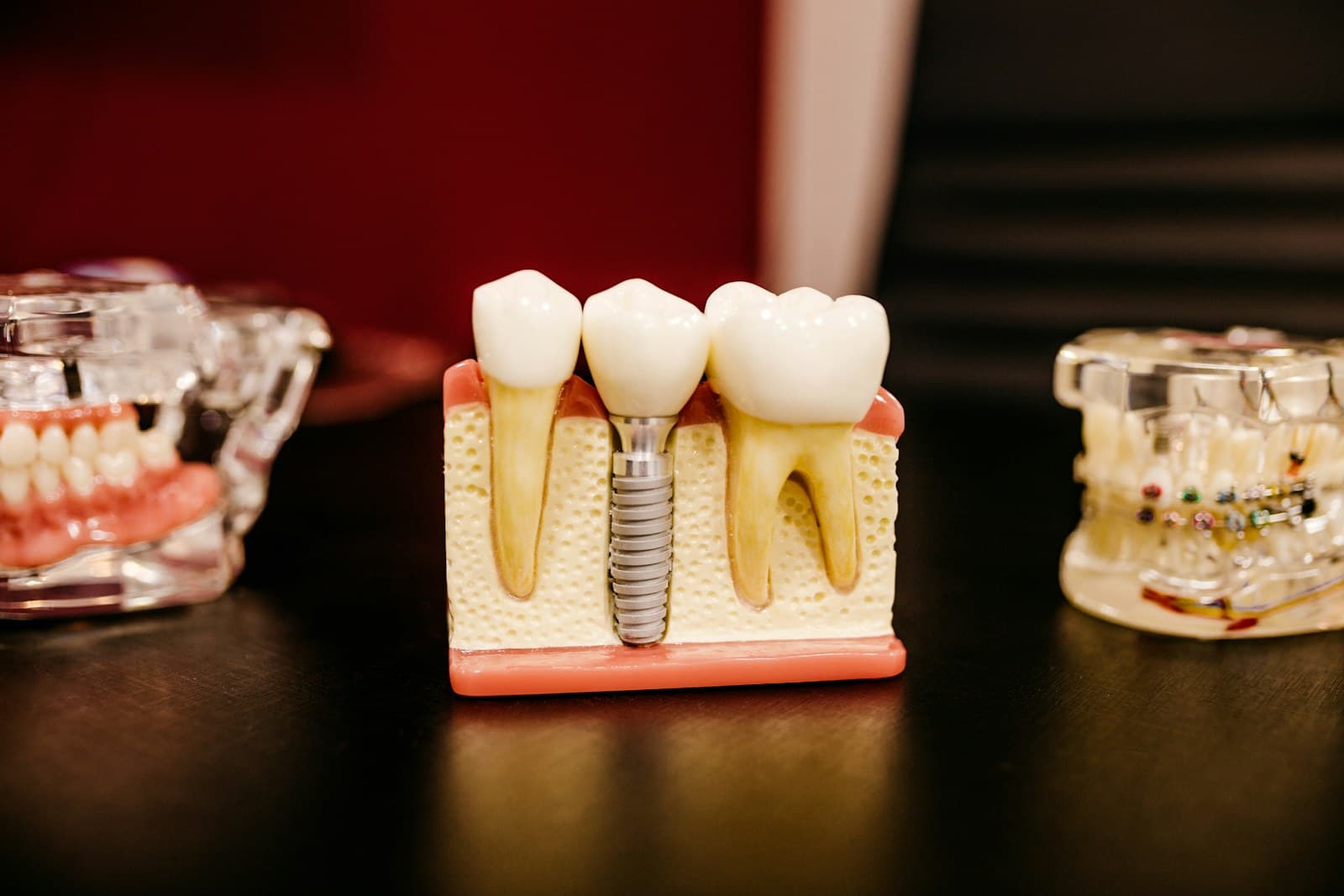 Diş implantı modeli üzerinde implant yerleşimi